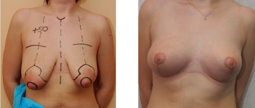 Før og efter foto af brystforstørrelse
