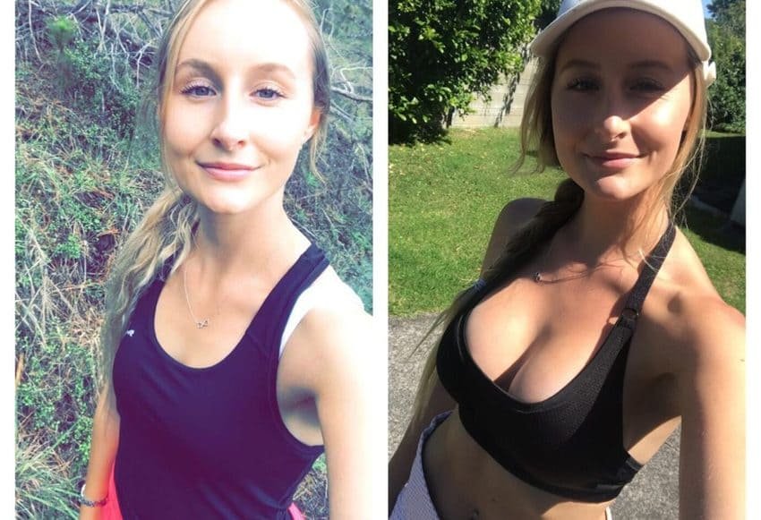 Før og efter foto af brystforstørrelse