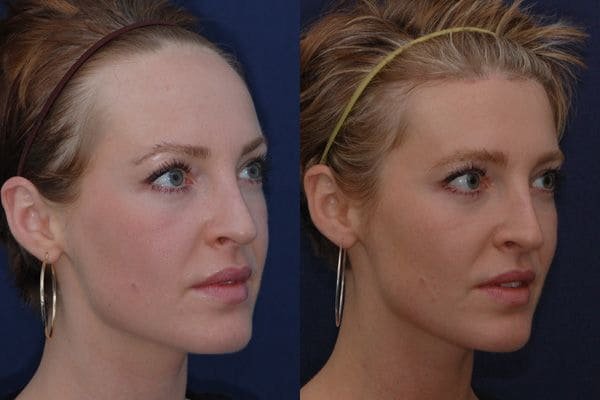 før og efter foto af sænkning af pandelinjen hos kvinder