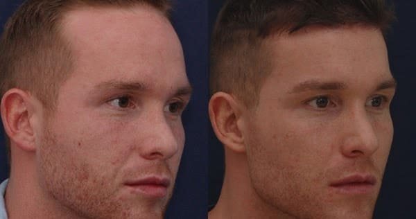 sænkning af pandelinjen hos mænd