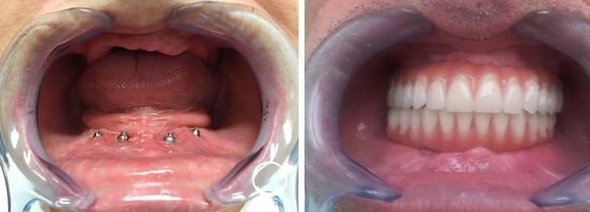 Tandimplantat på 4 abutments