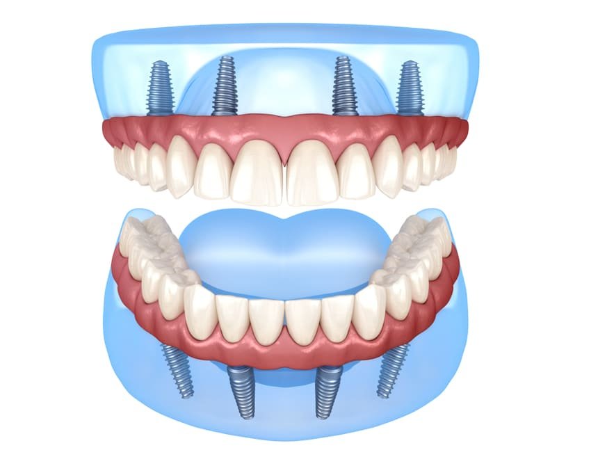 Computergenereret billede af en over- og underkæbe med en All-on-4