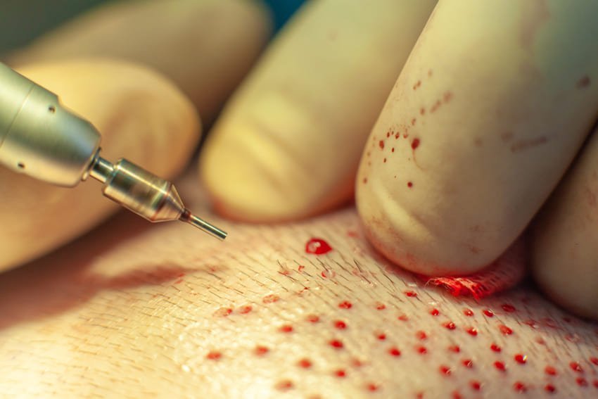 graftimplantat efter DHI-metoden