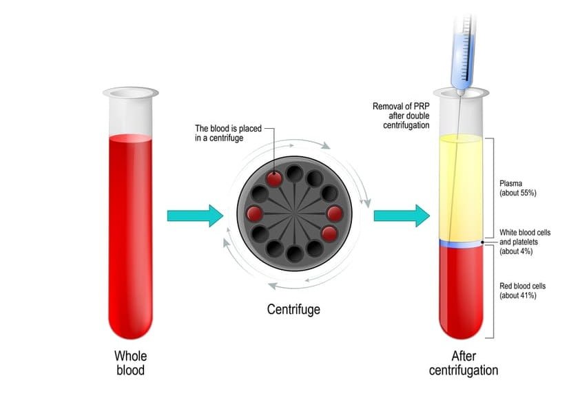 PRP-behandling og blodrensning