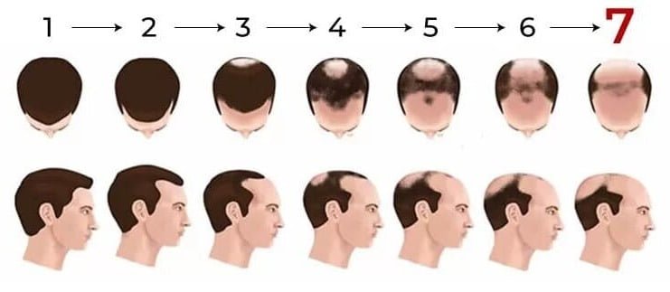 Diagram af Norwood skaldethed skalaen