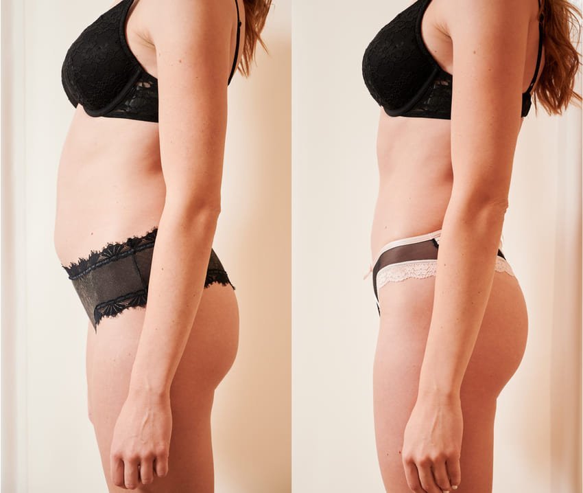 Før og efter foto af en kvindes abdominoplastik