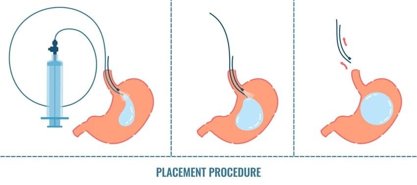 Procedure for placering af gastrisk ballon