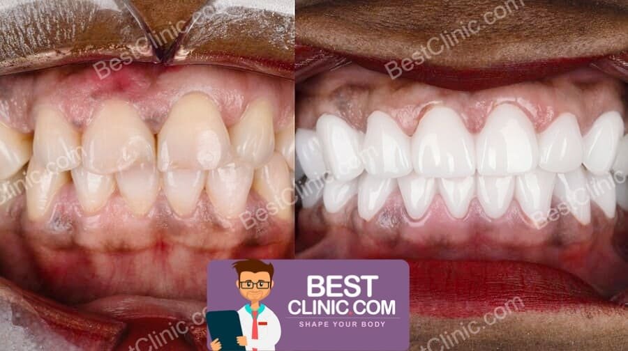 avant apres facette dentaire turquie