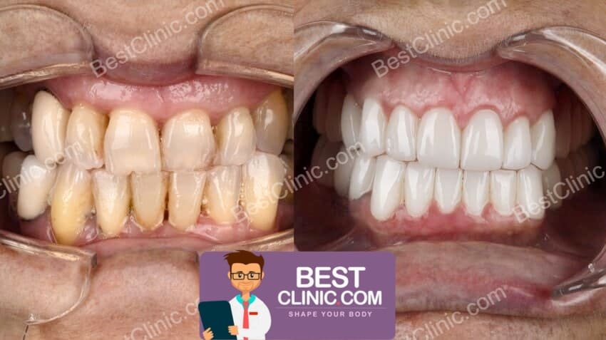 avant apres facette dentaire turquie