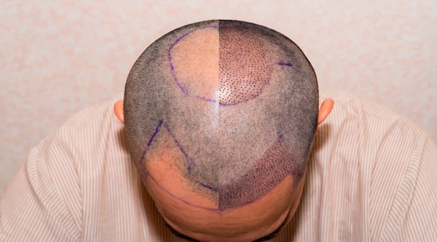 Resultat før og efter hårtransplantation