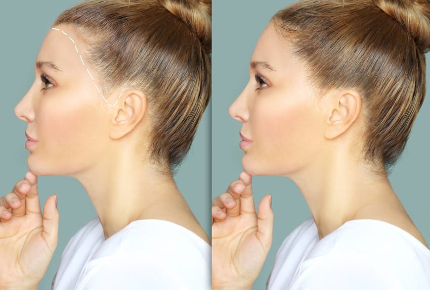 Simulering af frontallinjereduktion