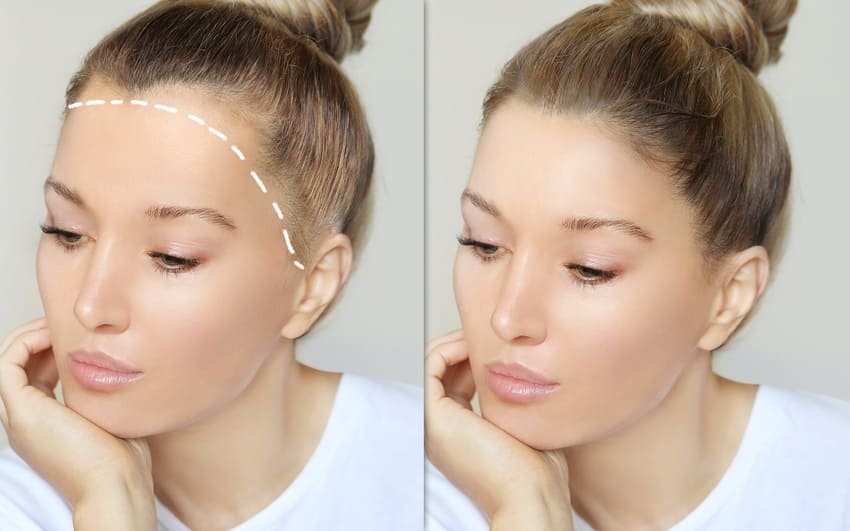 Simulering af pandereduktion hos kvinder