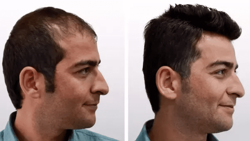 Foto før og efter hårtransplantation i Türkiye