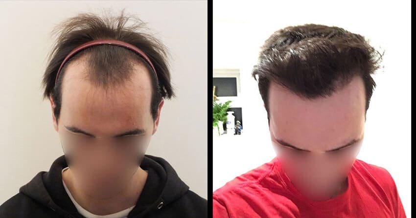 før og efter foto af en hårtransplantation