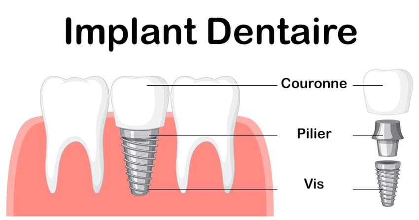 Tandimplantatdiagram med krone, abutment og skrue.